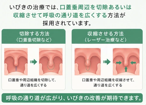 いびきの治療方法